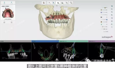 病例報(bào)道│全程數(shù)字化輔助無牙頜種植即刻負(fù)重