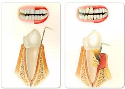 上海嘉?？谇谎芯克皇兰o牙周病的臨床進展