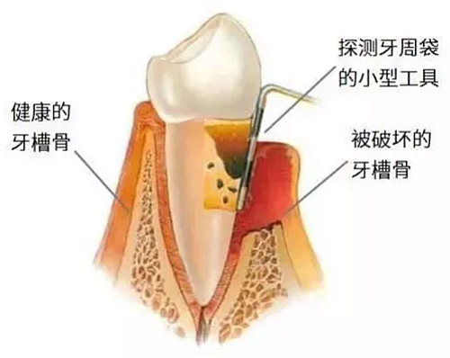 上海嘉?？谇谎芯克皇兰o牙周病的臨床進展