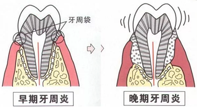 上海嘉?？谇谎芯克皇兰o牙周病的臨床進展