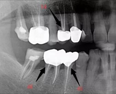 上海嘉福口腔研究所二十一世紀(jì)根管治療的進展