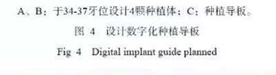 下頜骨腓骨移植聯(lián)合牙種植術(shù)后的覆蓋義齒修復(fù)1例