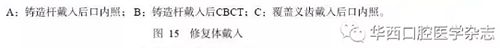 下頜骨腓骨移植聯(lián)合牙種植術(shù)后的覆蓋義齒修復(fù)1例