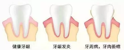 牙周炎，中國成年人后半生永遠的 痛 ！