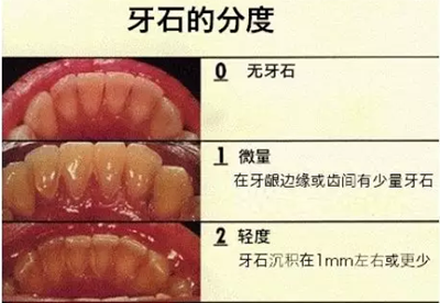 牙周炎，中國成年人后半生永遠的 痛 ！