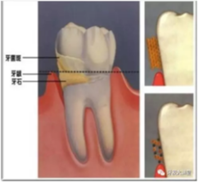 牙周炎，中國成年人后半生永遠的 痛 ！