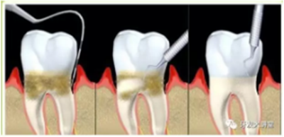 牙周炎，中國成年人后半生永遠的 痛 ！