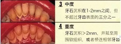 牙周炎，中國成年人后半生永遠的 痛 ！