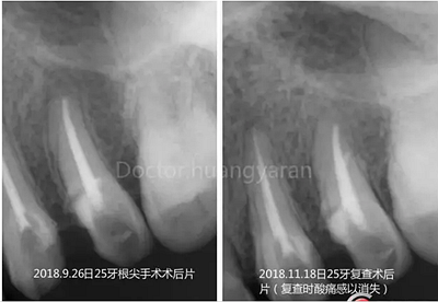 當(dāng)根管治療遇見根尖骨穿孔