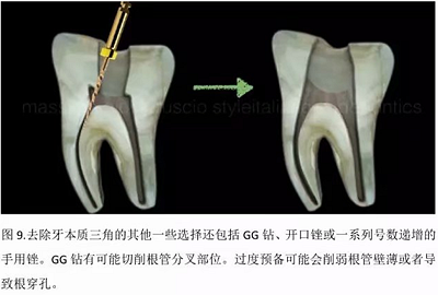 【病例分享】根管冠部預敞