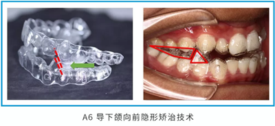 兒童早期矯治問題