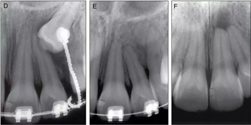 【病例分享】治療后的根尖周炎與根尖外的獨(dú)立感染