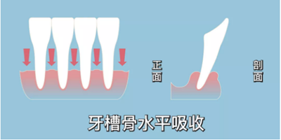 正畸矯正