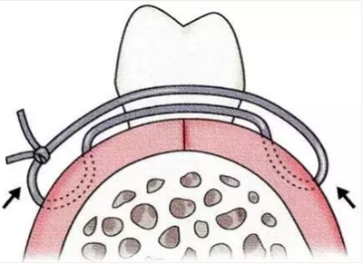 【牙周外科的基本技術技能】術后管理
