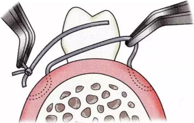 【牙周外科的基本技術技能】術后管理