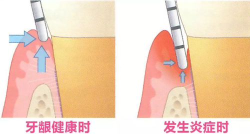 牙周探診SRP