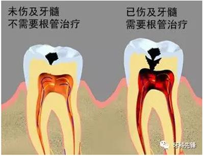 補(bǔ)牙不做冠，療效少一半！根管治療后牙齒已經(jīng)不疼了，為什么還要戴牙冠呢？