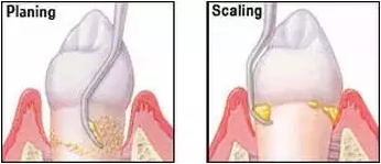 為什么洗牙后還要做牙周刮治？