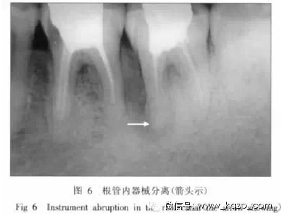 X線牙片在牙齒疑難病例診斷中的參考價(jià)值