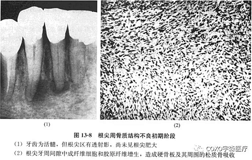 根尖周牙骨質(zhì)結(jié)構(gòu)不良初期階段