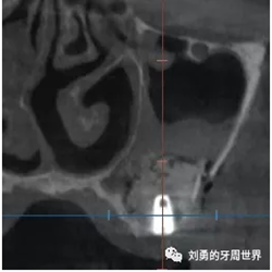 一例失敗上頜竇種植患者的補救