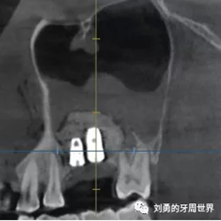 一例失敗上頜竇種植患者的補救