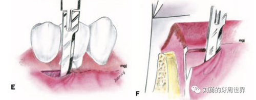 FGG游離牙齦移植在歷史上的各種改良以及發(fā)展前景