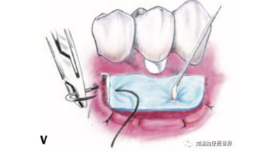 FGG游離牙齦移植在歷史上的各種改良以及發(fā)展前景