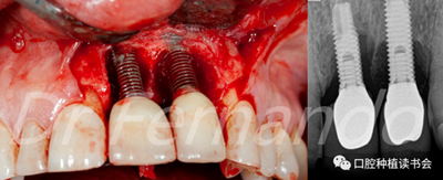 種植體周圍炎的軟硬組織重建治療（上）