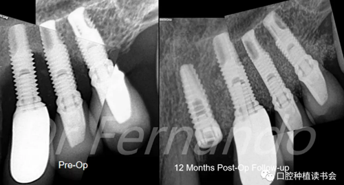種植體周圍炎的軟硬組織重建治療(下)