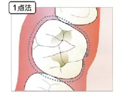 牙周袋深度測(cè)定法