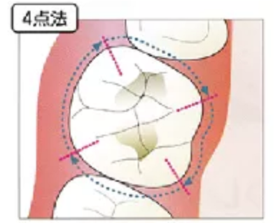 牙周袋深度測(cè)定法