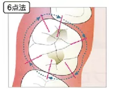 牙周袋深度測(cè)定法