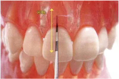 牙周袋深度測(cè)定法