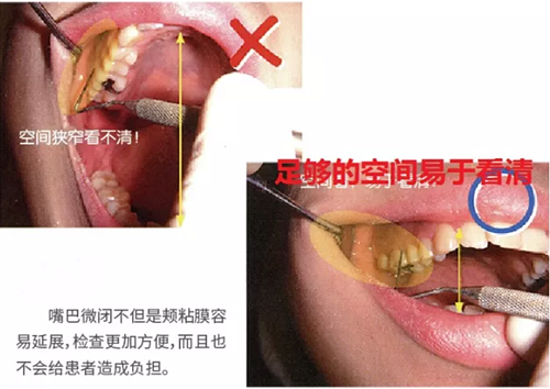 牙周袋深度測(cè)定法