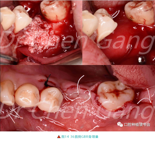 高清圖解｜游離牙齦（FGG）的獲取與移植技術(shù)