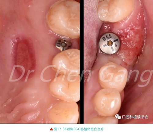 高清圖解｜游離牙齦（FGG）的獲取與移植技術(shù)