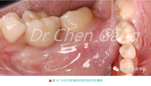 高清圖解｜游離牙齦（FGG）的獲取與移植技術(shù)