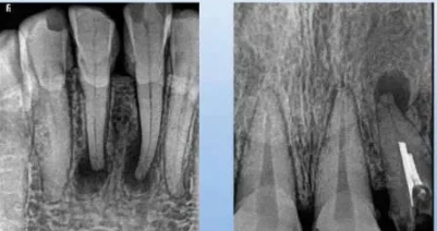 各類根尖周病的X片表現(xiàn)