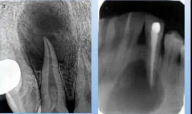 各類根尖周病的X片表現(xiàn)
