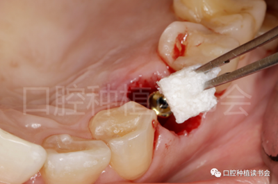 后牙區(qū)即刻種植臨床指南