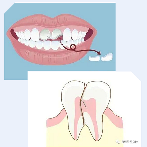 口腔科普 | 殘根殘冠怎么辦——樁核冠