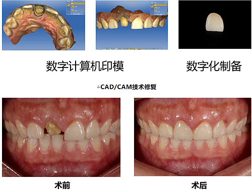 妙手牙醫(yī)丨殘根、殘冠還有保留的意義嗎？