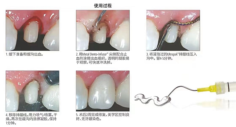 皓齒止血排齦凝膠