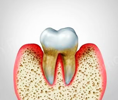 牙周病總是來(lái)勢(shì)洶洶？有辦法預(yù)防嗎？